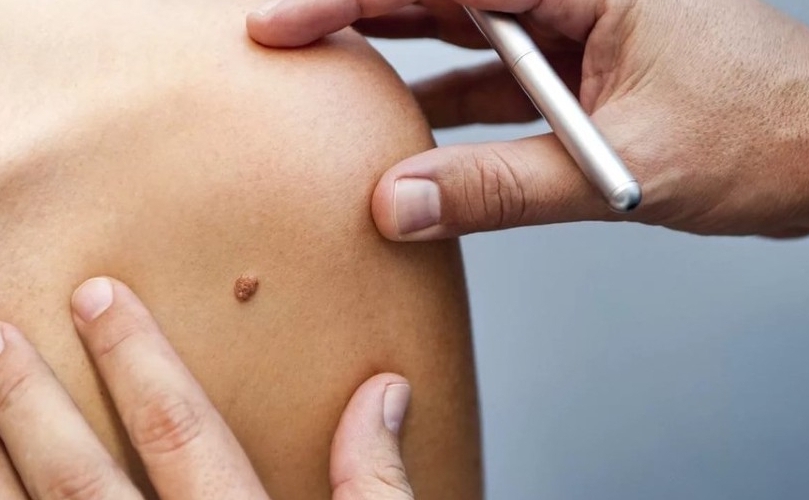 Neues Medikament stoppt das Wachstum von Melanomen und Metastasen