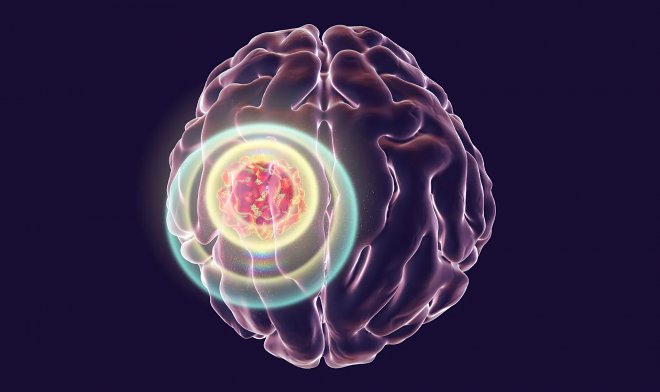 L'impianto a infrarossi nel cranio ha mostrato efficacia nella lotta contro il cancro al cervello