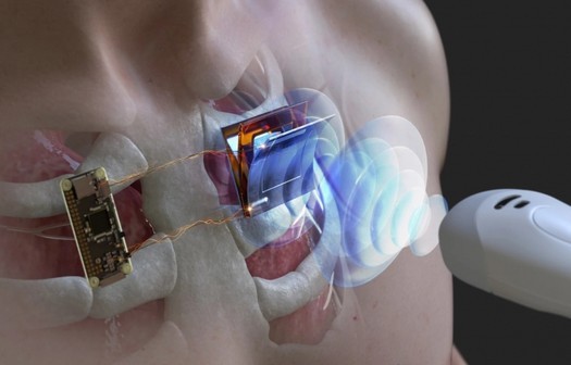 科学者は、超音波を使用してペースメーカーやその他のインプラントを充電する方法を発見しました