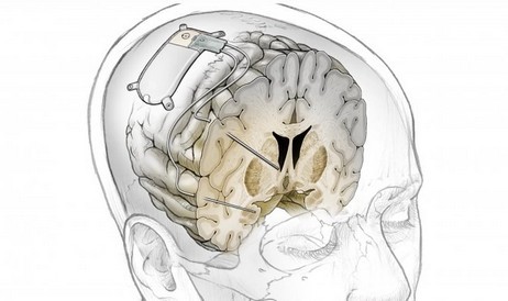 Experimentelles Gehirnimplantat wird unheilbare Depressionen sofort lindern