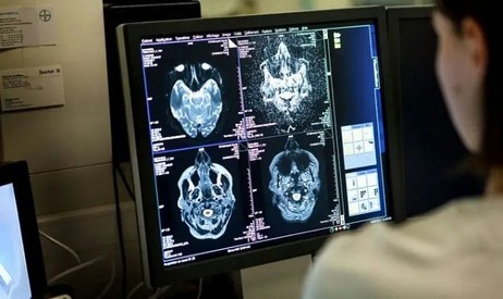 Le coronavirus peut gravement endommager le cerveau