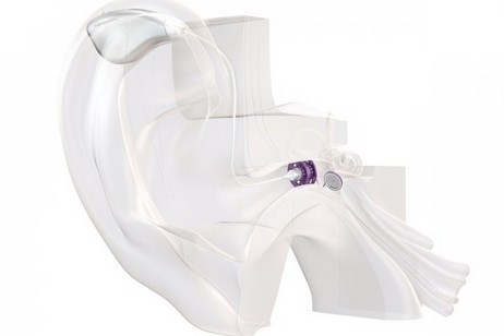 Vibrosonic crea lenti acustiche per sostituire gli amplificatori uditivi